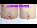 ariana spa supplies 5 in 1 ultrasonic cavitation vacuum rf body slimming skin lifting