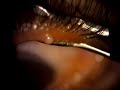 Eyelid squeezing - popping a stye