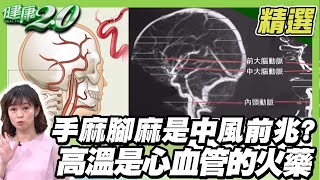 手麻 腳麻 是中風前兆？高溫是心血管的火藥 32°C以上中風機率高66％ 【健康2.0精選】