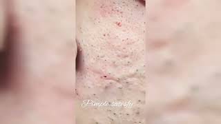 MASSIVE Pimple Popping Compilation! YOU WON'T REGRET WATCHING THIS! #002