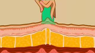 How Cupping massage works our body skin layers