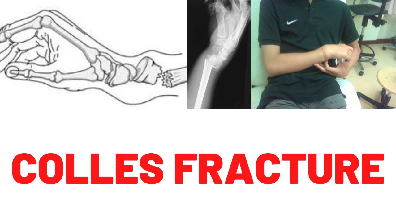 Colles Fracture Vs Smith Fracture X Ray Nibhtbus