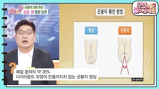 [무엇이든 팩트체크] 손끝의 곤봉 현상 심장, 폐 질환 징후 [무엇이든 물어보세요] | KBS 250207 방송