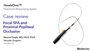 SFA Popliteal Case Review - Dr. Naveed Saqib