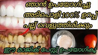 അഞ്ച് മിനിട്ടില്‍ പെട്ടെന്ന് പല്ല് വെളുക്കാൻ/How to whitening your teeth naturally /Get white teeth