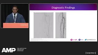 Dr. Joseph Blas: Treatment of Distal Embolization after Recanalization using the Pounce™ System