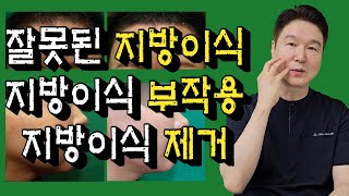 [지방이식부작용] 제거 안 하면 평생 갑니다. 잘못된 지방이식은 전문병원에서 확실하게 제거하세요.