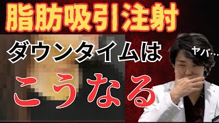 脂肪吸引注射のダウンタイムどんな感じ！？脂肪吸引との違い！