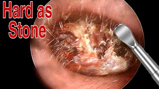 BIGGEST Ear Wax, Difficult Removal - EP2 | Doctor Anh