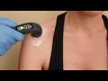 tecarpuls for frozen shoulder or adhesive capsulitis