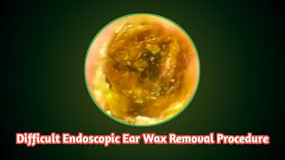 How to: Difficult Endoscopic Microsuction Ear Wax Removal Procedure