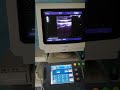 Aloka alpha 10 complete demo, gynae/obs echocardiography