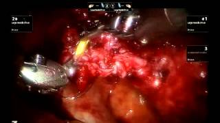 Robotic assisted laparoscopic repair of vesico-vaginal fistula: the extravesical approach