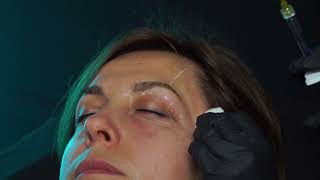 Jalupro Young Eyes | Canulla Injection by Dr Shelemba