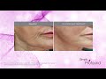 profound skin tightening system at london real skin