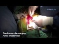 woundclot bleeding control in aortic anastomosis cardiovascular surgery