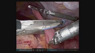 Robotic Repair Strasberg E1 Common Bile Duct Injury during Laparoscopic Cholecystectomy