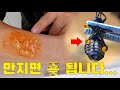 이거 만지면 진짜 큰일 납니다 한국에 몇 없는 맹독 곤충의 독을 발라보았습니다