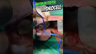 Hydrocele Treatment | Hydrocele surgery  - Jaboulay Procedure | Hydrocele Operation