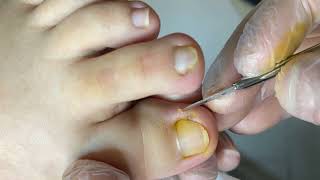 Pedicure Tutorials： Sharp nail treatment