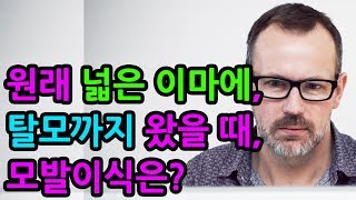 원래 이마가 넓은데 탈모까지 왔을 때, 모발이식은?