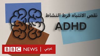 ما هو اضطراب نقص الانتباه وفرط النشاط؟  ADHD