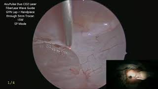 Hydrodissection of anterior Cul de sac   Dr  Mario Nutis   using FiberLase CO2 fiber