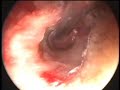 endoscopic myringotomy grommet insertion