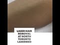 Laser Hair Removal