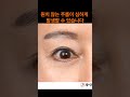 눈처짐에 눈매교정을 하면 생기는일 - 제이제이성형외과#shorts