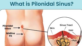 "Pilonidal Sinus: Causes, Symptoms, and Treatment Options" I Pilonidal Sinus Treatment in Delhi