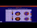 aioc2018 gp028 topic best available solutions for a case of cataract and keratoconus....