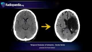 Stroke: Evolution from acute to chronic infarction - radiology video tutorial (CT, MRI)