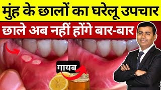 मुंह के छालों (Mouth Ulcers) के 5 घरेलू उपाय | एक बार में मुंह के छाले गायब