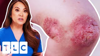 Woman Spent YEARS Struggling With Infected Skin Due To Misdiagnosis | Dr. Pimple Popper