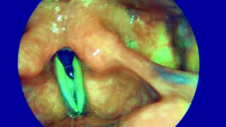 Vocal cord nodule