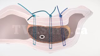 Blumgart-style Pancreaticojejunostomy