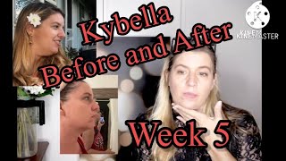 KYBELLA BEFORE AND AFTER Double Chin Removal @LifeQuestBeauty