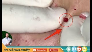 How To Removal Blackheads, Finding Blackheads Chow Stephen By Dr. Sok Mean Healthy (Part 13)