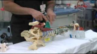 Surgical Procedures - Extracavitory Lateral Interbody Fusion (XLIF)