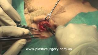 Отопластика, пластика ушных раковин | Otoplasty, Ear Reshaping | Live Surgery