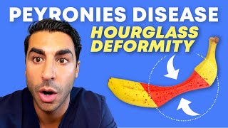 Peyronie’s Disease and Hourglass Deformity | Los Angeles Urology | Justin Houman MD Beverly Hills