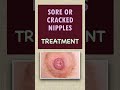 sore nipples in breastfeeding moms prevention and management