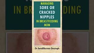 Sore nipples in breastfeeding moms | Prevention and management