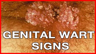 How to Recognize Genital Warts Signs