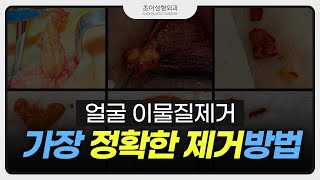 얼굴 이물질 제거! 직접 보면서 해야 정확합니다!🤓