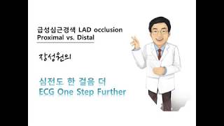 심전도 한 걸음 더 31. 급성심근경색 LAD proximal vs distal