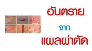 พบหมอเสรี ตอนที่ 493 : อันตราย ที่มาจากแผลผ่าตัด