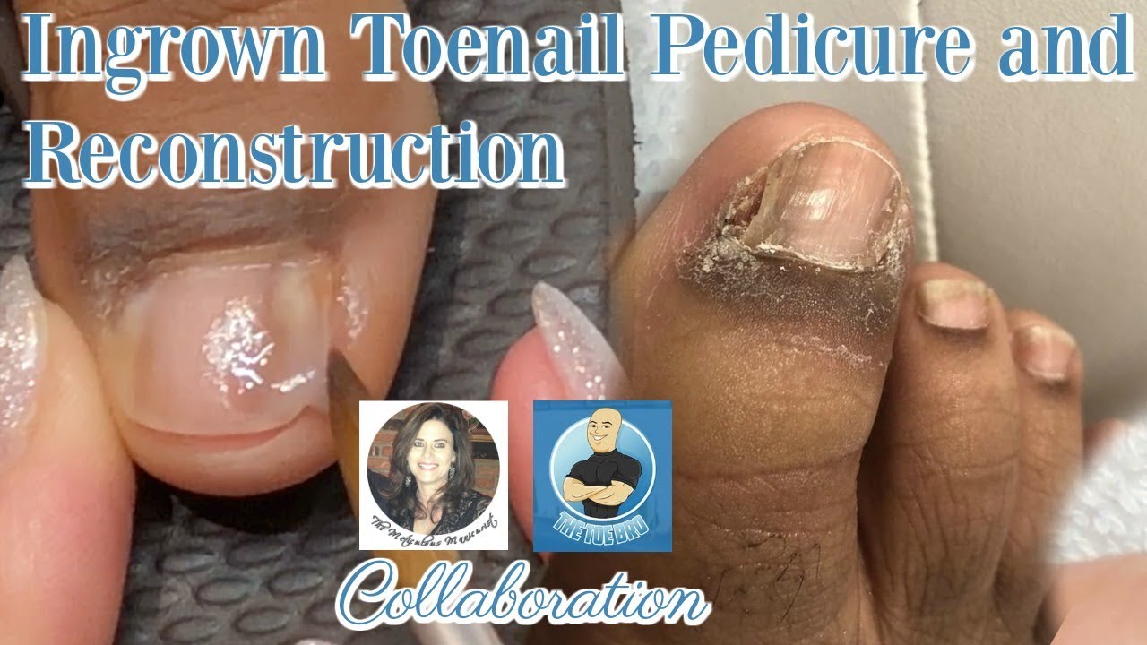 Pedicure With Toenail Reconstruction After Ingrown Toenail Removal With ...