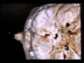 3d Model of a CT Scanned Human Head